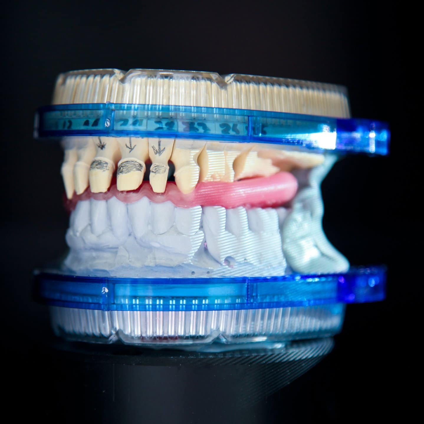 Occlusal Adjustment in Dental Prosthetics Construction